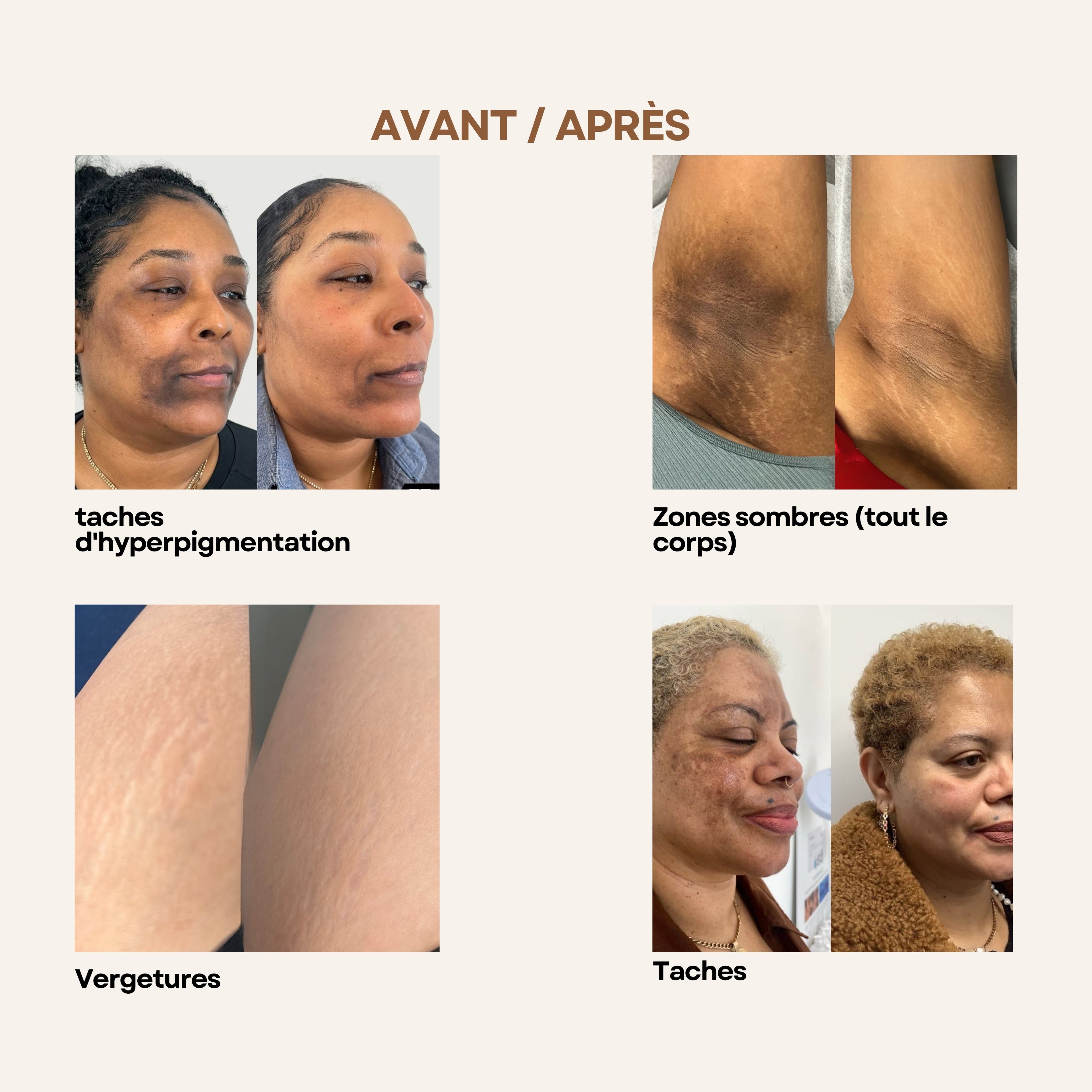 Routine premium Anti-Vergetures, hyper pigmentation & Taches – Huile + 2 Crèmes Raffermissantes